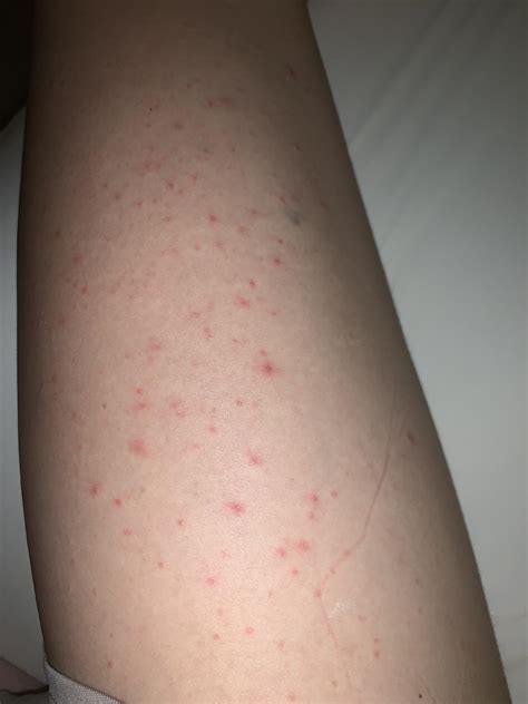 [misc] Red dots on legs?? : r/SkincareAddiction