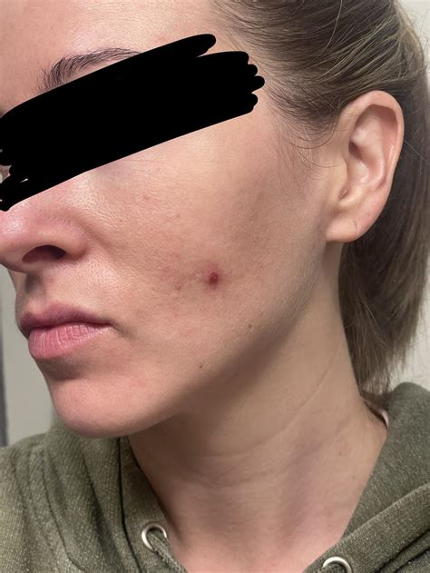 [Acne] Help me heal this blemish, please 😥 : r/SkincareAddiction