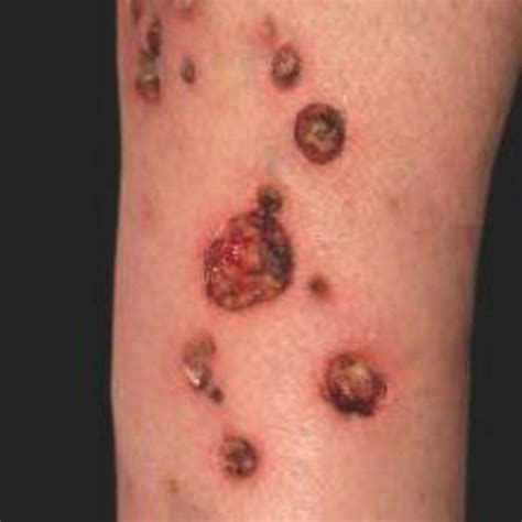 Ecthyma Contagiosum