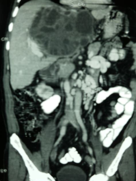 identify  side view endoscopy image showing  gelenatous