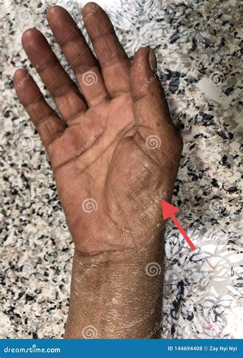 painful thenar muscle  asian man concept  compartment syndrome