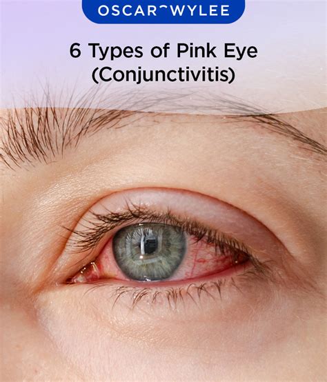 types  pink eye conjunctivitis