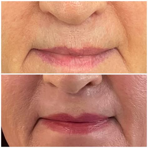 Laser Skin Resurfacing For Lip Lines at Jocelyn Wilson blog