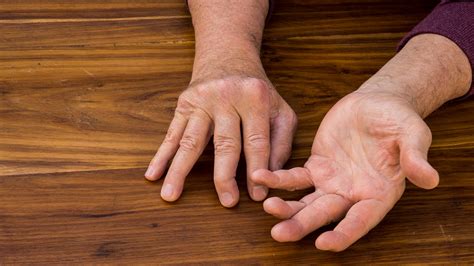 Do You Get Disability Benefits for Psoriatic Arthritis? - GoodRx