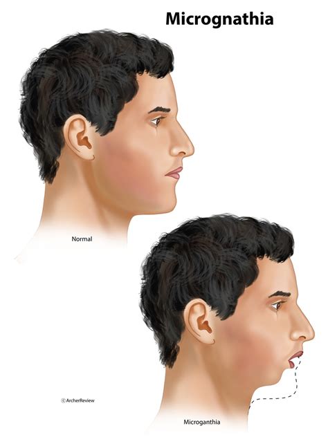 micrognathia illustration  suzanne hayes medical illustration