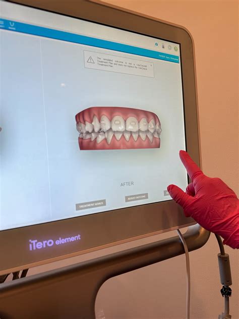 My Crossbite Invisalign Before and After Results in 10 months