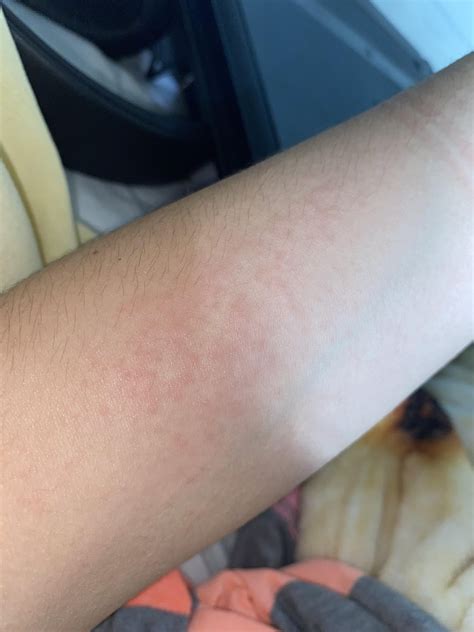 Is this a lamictal rash? : r/lamictal