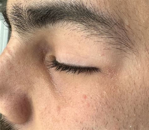 left healed uoper eyellid incision custom midface implant dr barry