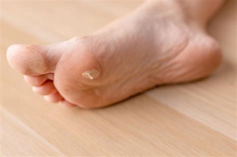 Premium Photo | Blisters skin on the soles of the feet Closeup