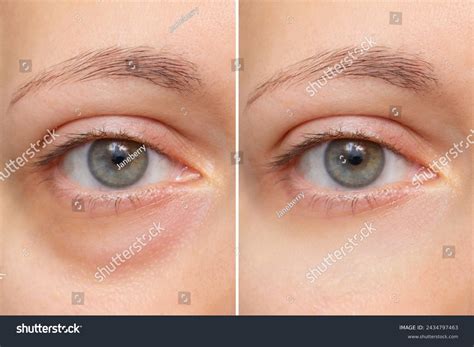 puffiness    images pictures shutterstock