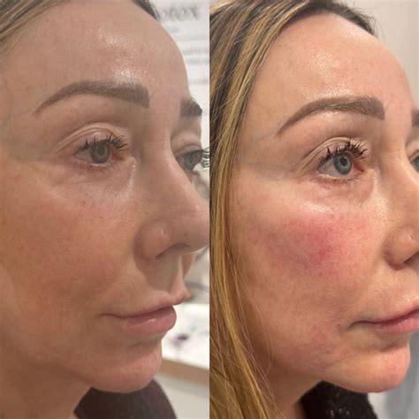 Vickis Dermal Filler Transformation