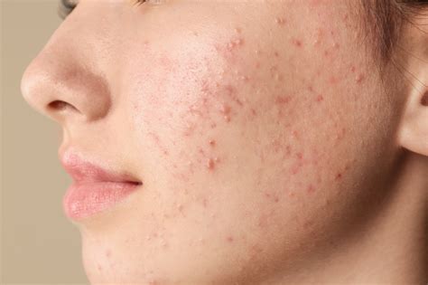 comprehensive guide  eliminate moles   face completely