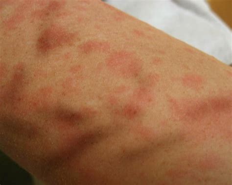 Causes Of Skin Rashes With Itching at George Keys blog