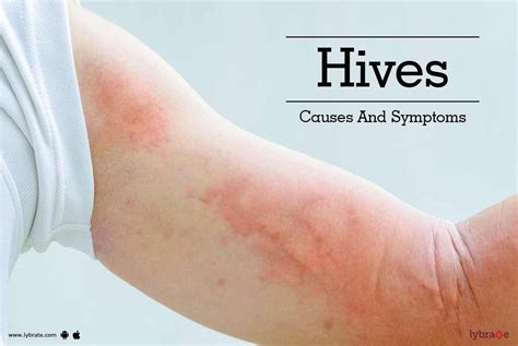 Hives Causes Treatment And Conditions Wiki Itchy Mind Images