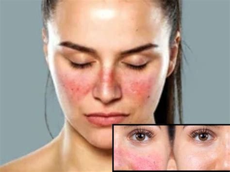lupus  key symptoms treatment options  latest research