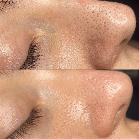 Hydrafacial Brisbane — 30-Min Glow, Effective & Non-Invasive