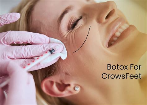 Botox Crows Feet Ogden Utah - Remove Wrinkles Around Eyes