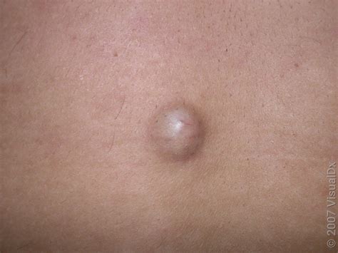 Sebaceous Cysts: Removal and Treatment (With Images) - GoodRx