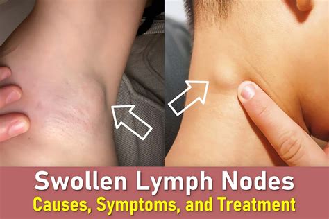 occipital lymph nodes swollen  side