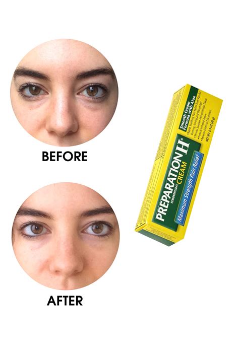 How to get rid of under eye bags – Artofit