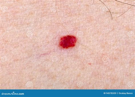 Angioma On The Skin. Red Moles On The Body. Many Birthmarks. Stock ...