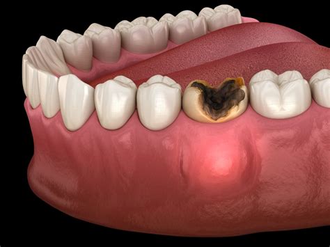 5 Stages Of An Abscessed Tooth & What To Do