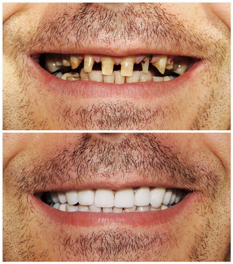 What Is a Full Mouth Reconstruction | Creekwood Dental Arts
