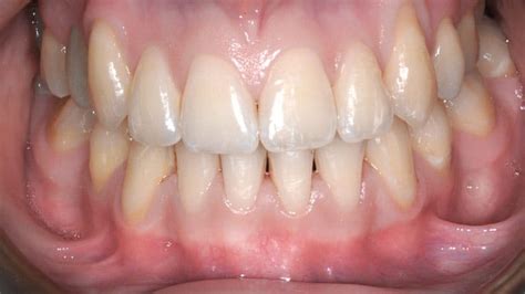 raddrizzare  denti storti soluzione affollamento mp dental studio