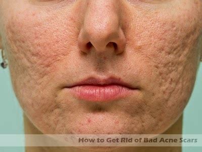 How to Get Rid of Bad Acne Scars - 3 easy tips | Hormonal Acne Tips