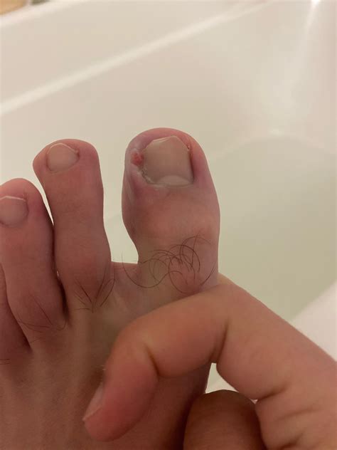 How bad is it and should I see a doctor it is now starting to hurt : r