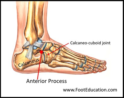 Anterior Process Fracture of the Calcaneus - FootEducation