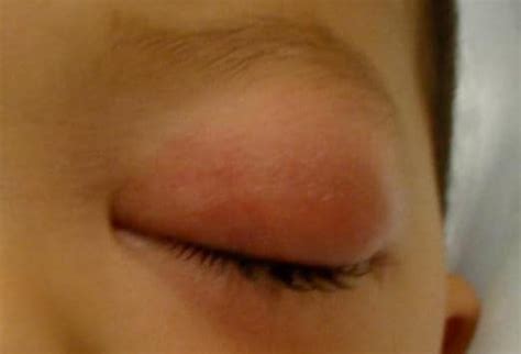 Common Indications for Pediatric Otolaryngologic Surgery