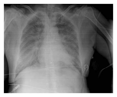 Chest X-ray after Angio-Seal placement. | Download Scientific Diagram