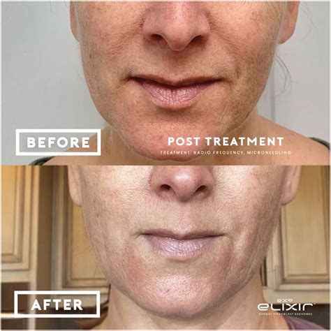 exo anna avaliani md cosmetic laser surgery anna avaliani md