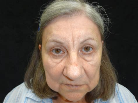 Eyelid Surgery Before and After Photos by William Dascombe, MD