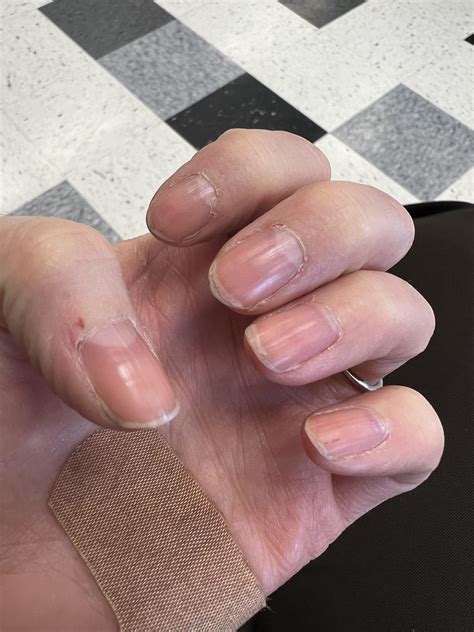 Healthy Nails Vs Unhealthy Nails