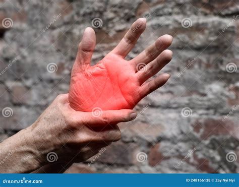 Painful Palm Of Asian Man. Concept Of Compartment Syndrome, Cellulitis ...