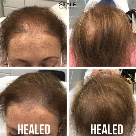 thinning hair women scalp