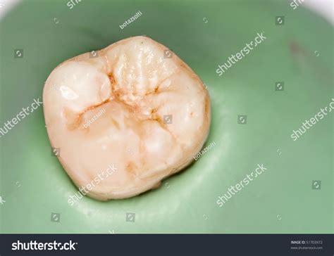 Human Tooth Incipient Caries Stock Photo 51703972 | Shutterstock