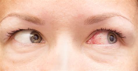 Healthy And Irritated Eye Stock Photo - Download Image Now - iStock