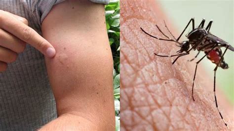 mosquito bite reason  mosquito bite  dengue  malaria
