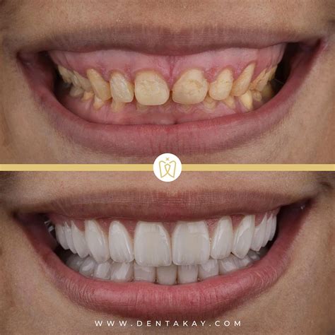 Hollywood's Biggest Secret? Dental Experts Uncover The Truth Behind Tom Cruise's Iconic Smile Image 17