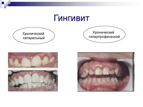 Болезни пародонта у детей - презентация онлайн