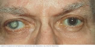 Cataracts | Riemer Eye Center