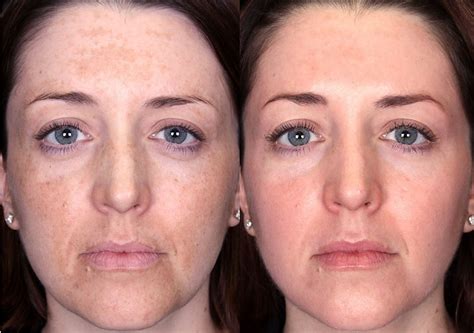 Peeling De Hollywood Antes E Depois - Hollywood Peel | N+P
