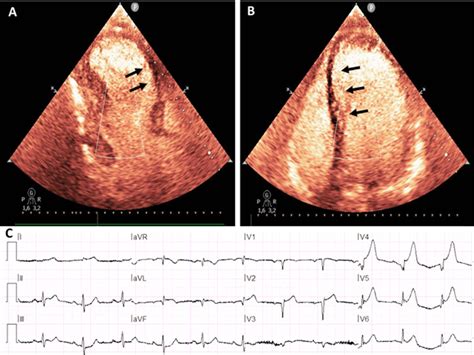 Case 3: Contrast echocardiography and ECG. A, B Contrast... | Download ...