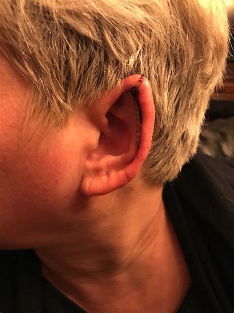 Plastic Surgery Elf Ears Elfie (@__elfie___) Ear Pointing Journey: