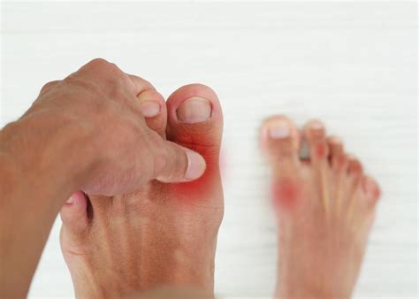 signs  symptoms  gout   big toe