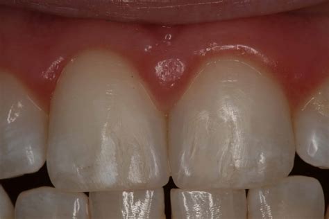 Before & After Smiles - Dr. Gerald Chan - Gaithersburg Dentist