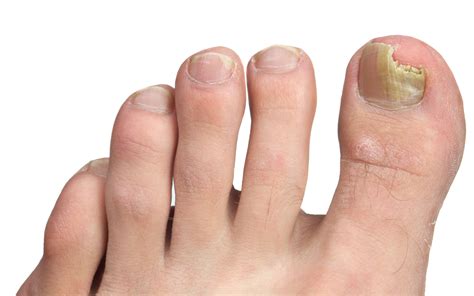 Should You Get Fake Toenails For Fungus? Learn The Truth! – DNF